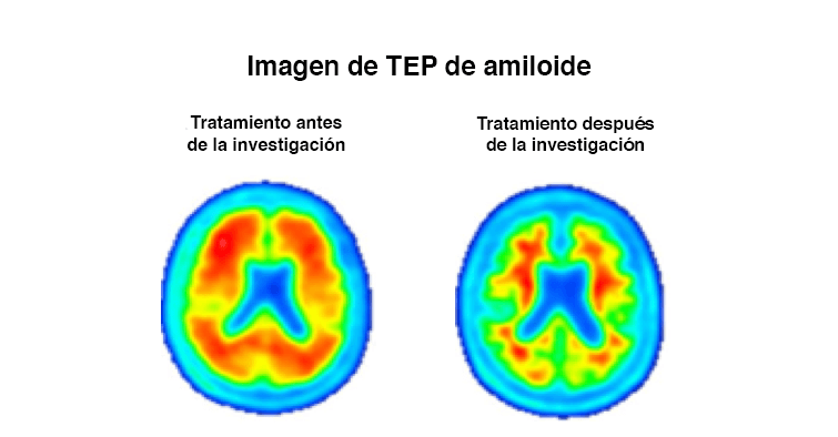 Side by side PET scan of amyloid build-up in the brain in Spanish